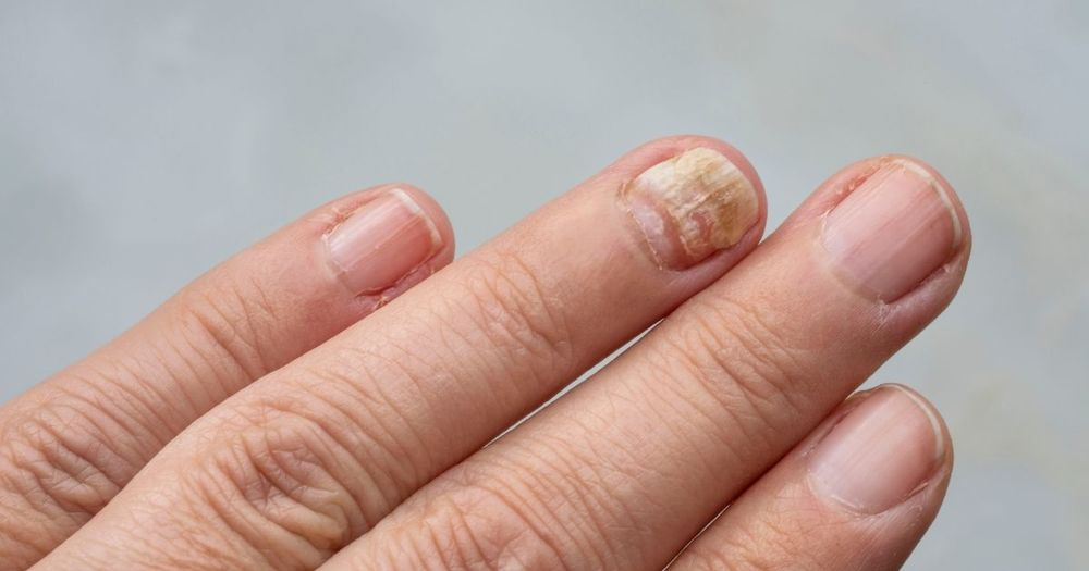 7 Holistic Remedies for Severe Fungal Nail Infections You Need to Try!