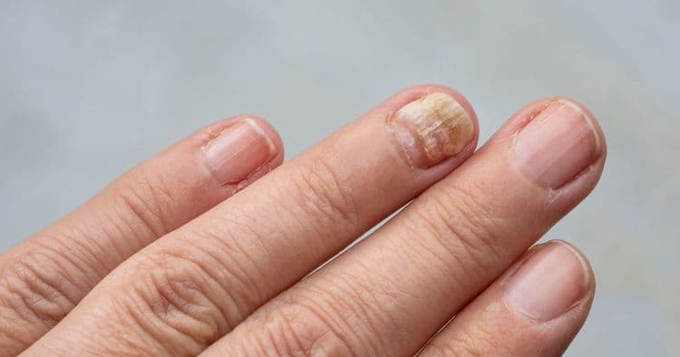7 Holistic Remedies for Severe Fungal Nail Infections You Need to Try!