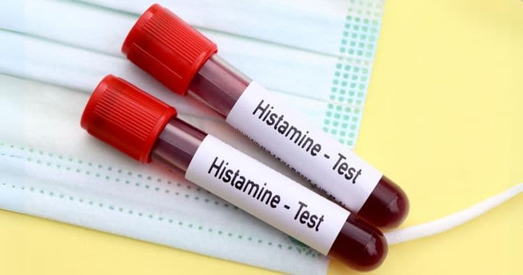 Histamine Intolerance: The Hidden Trigger Behind Your Mystery Symptoms